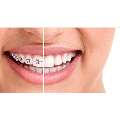 tratamiento con ortodoncia