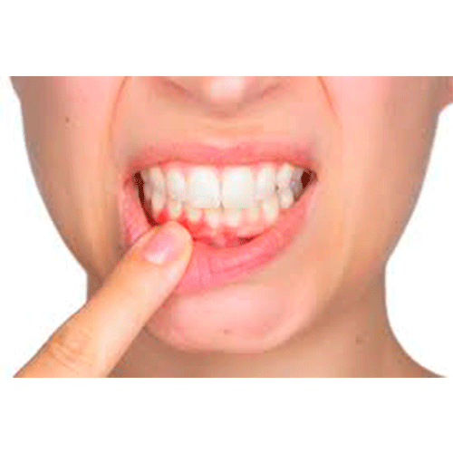 boca con gingivitis