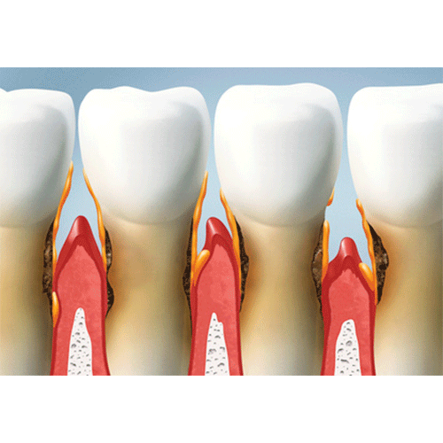 detalle de dientes con priodontitis