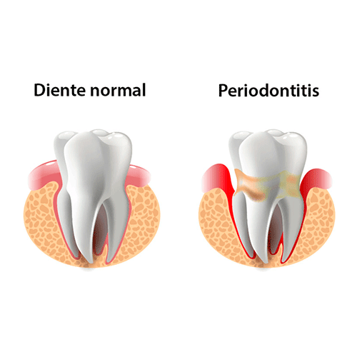 diferencia de entre un diente normal y uno que sufre periodontitis